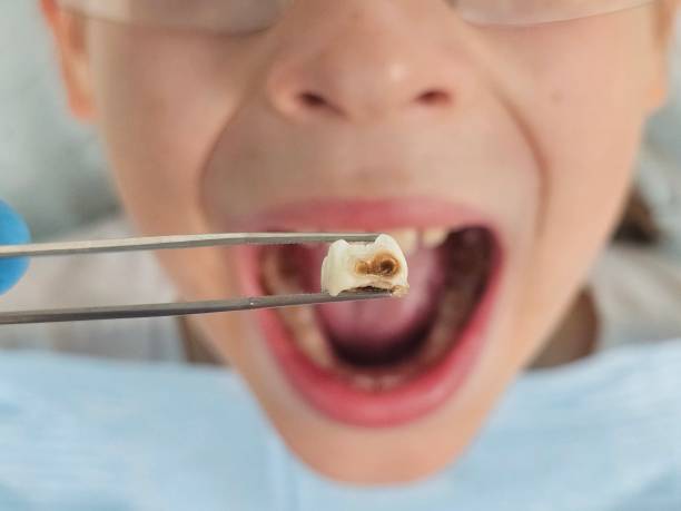 Best Emergency Dentist for Knocked-Out Tooth in Eglin Af, FL